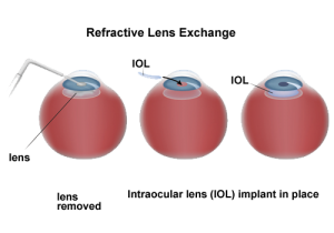 refractive lens exchange