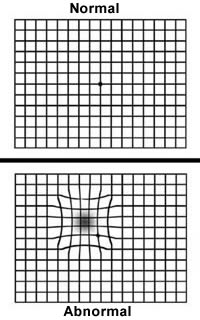 Amsler Grid Test for Retinal Conditions, When to See a Doctor