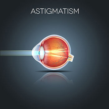 Astigmatism infographic