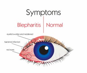 Symptoms of Blepharitis Compared to Normal Eye