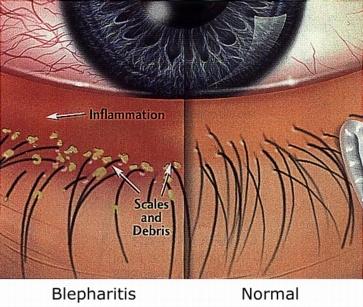 Blepharitis and normal eye comparison