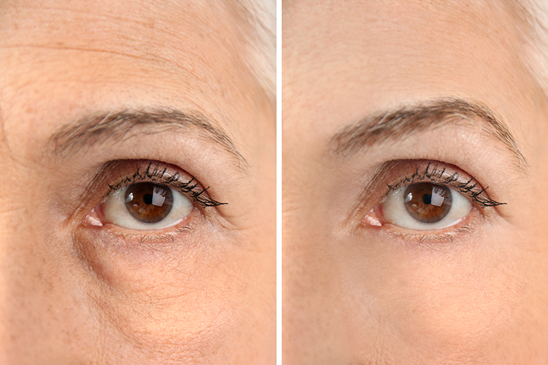 Mature woman before and after blepharoplasty eyelid lift