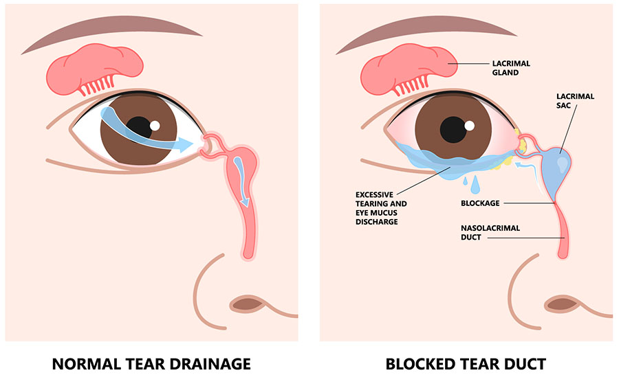 Blocked Tear Duct infographic