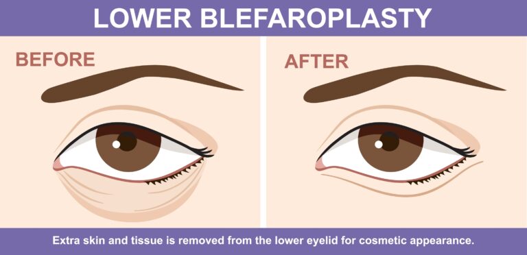 Lower blepharoplasty before and after infographic