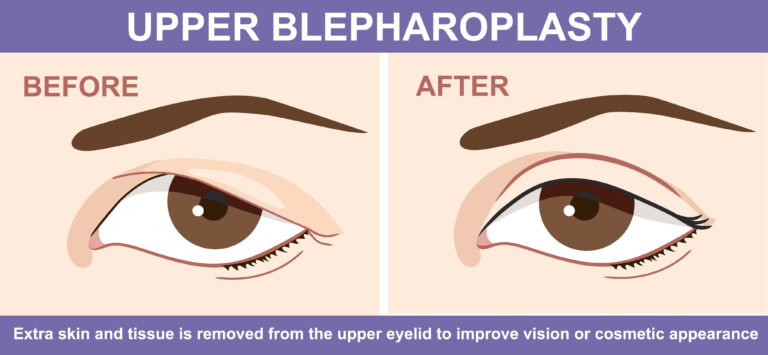 Upper eyelid surgery  before and after infographic