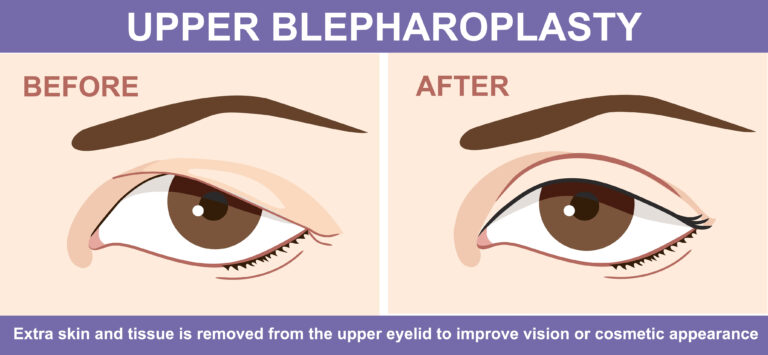 Upper eyelid surgery before and after infographic