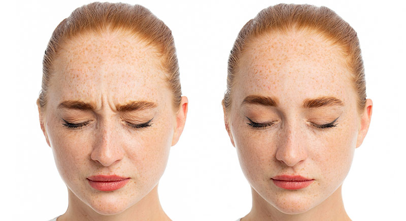 Frown lines before and after botox