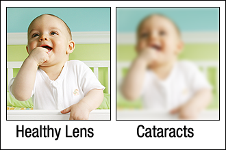 healthy lens vs cataracts 