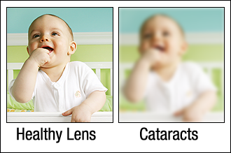 healthy lens vs cataracts