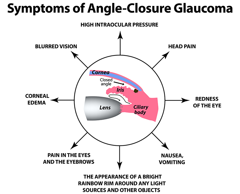 The symptoms of closed angle glaucoma Infographics