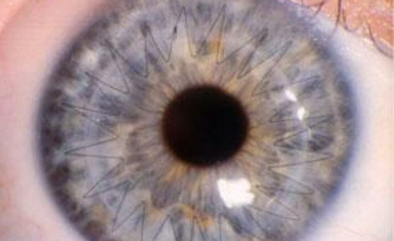 Close up of Corneal Cross Linking