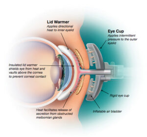 Diagram of how lipiflow works