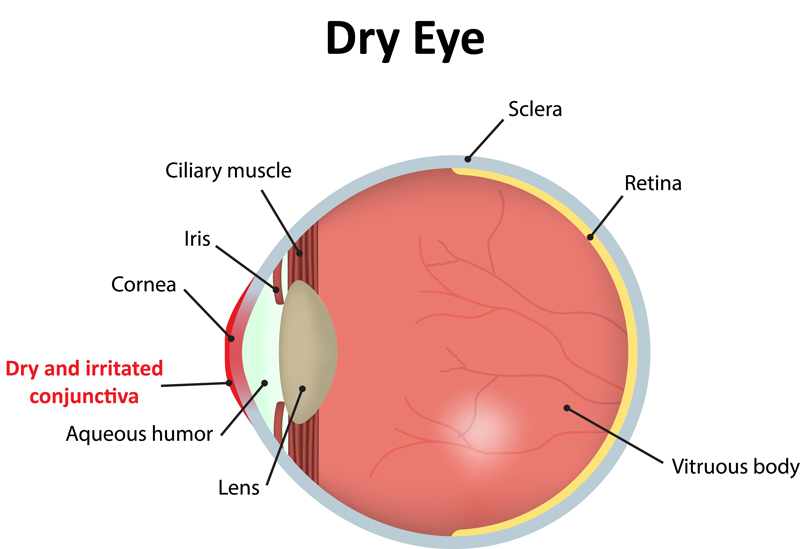 Diagram of Dry Eye