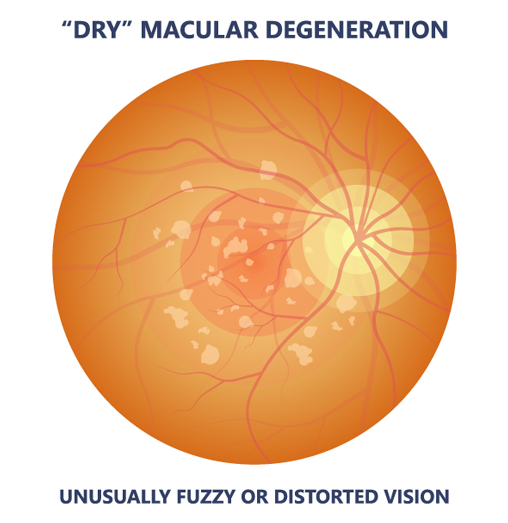 Eye with dry macular degeneration illustration