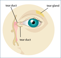 Diagram of Meibomian Gland Dysfunction