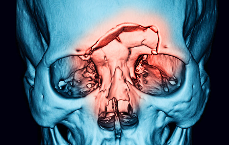 3d model of facial fractures