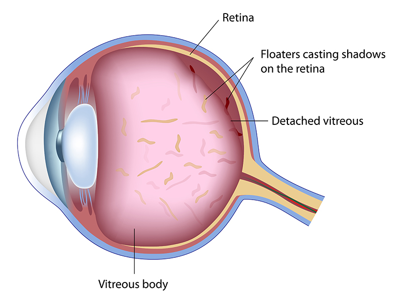 Floaters diagram