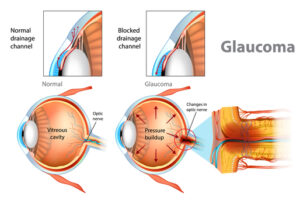 glaucoma diagram 