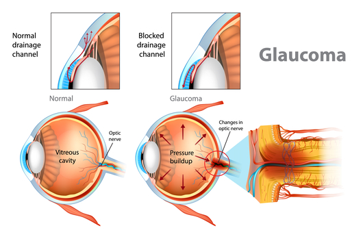 what is glaucoma