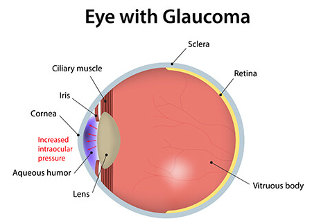 Glaucoma Eye Diagram