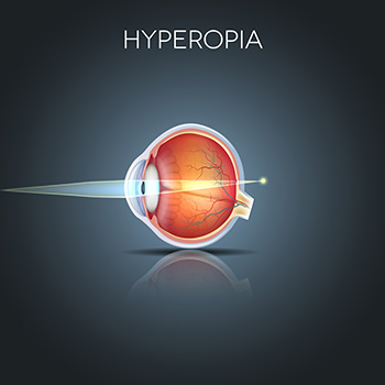 Hyperopia infographic