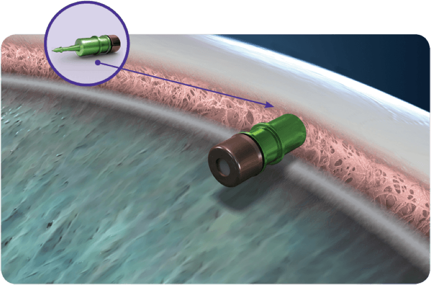 Travoprost Intraocular Implant