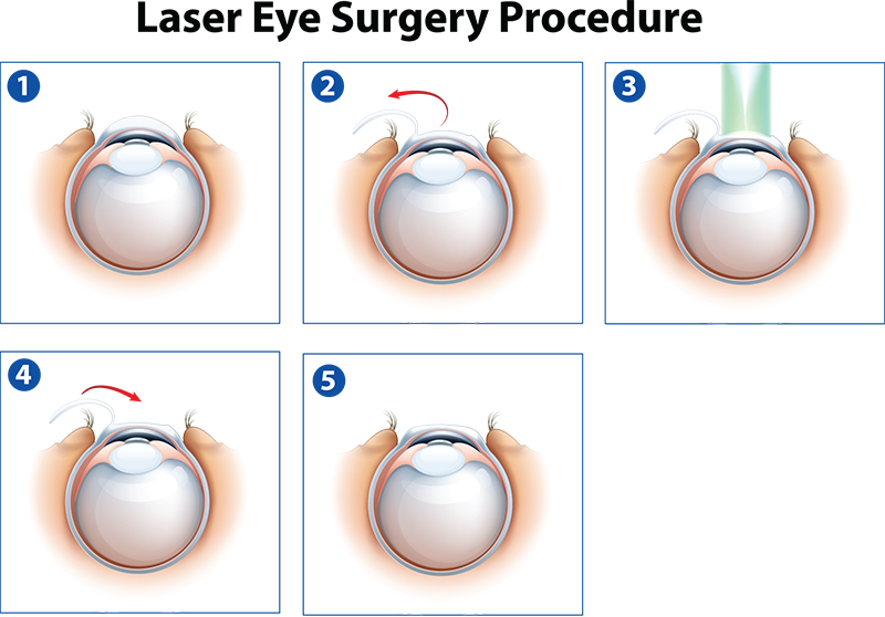 LASIK Procedure Steps