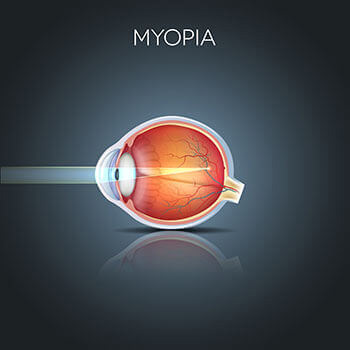 Myopia Infographic