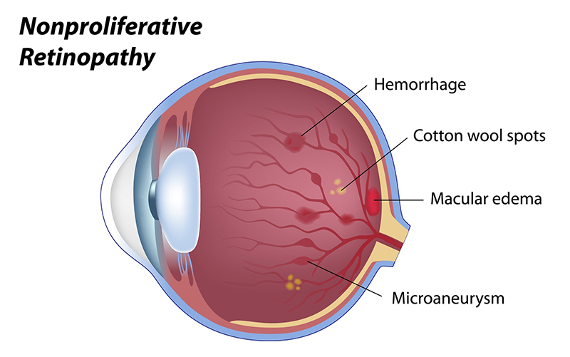 Non Proliferative Retinopathy infographic