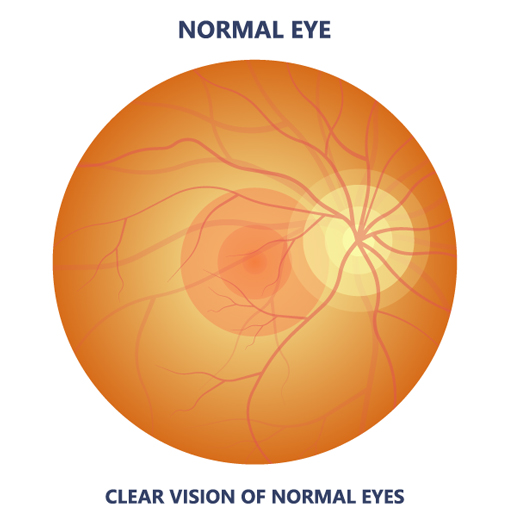 Normal eye without macular degeneration illustration
