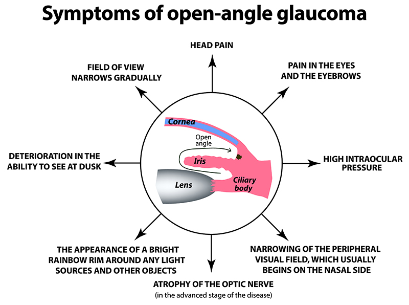 Symptoms of open-angle glaucoma infographic
