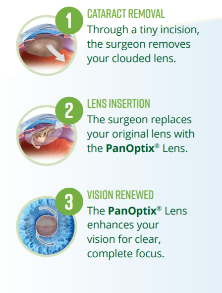 The Next Generation In IOLs: The PanOptix Trifocal IOL