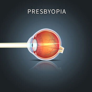 Presbyopia infographic