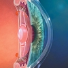 Presbyopia diagram
