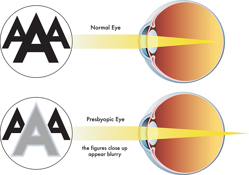 Presbyopia vs normal eye diagram