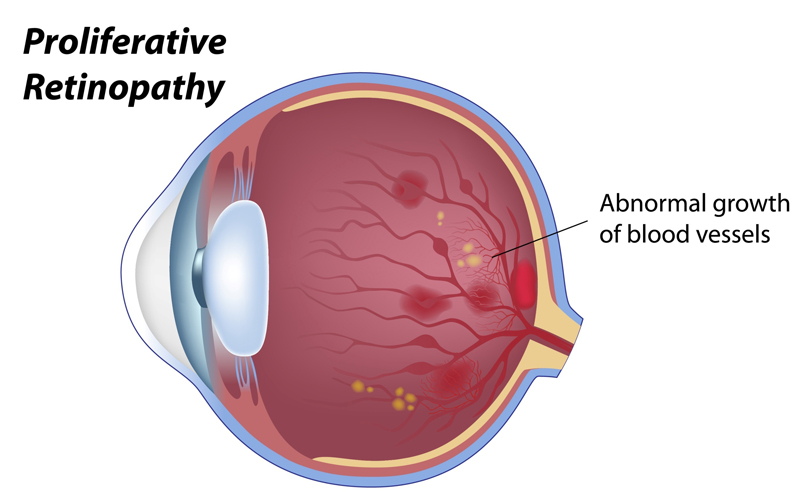 Proliferative Retinopathy infographic