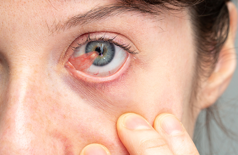 Macro of a blue eye of a girl affected by pterygium 