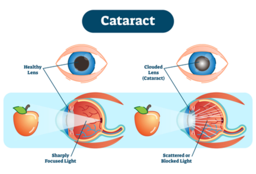 cataract surgery graph 