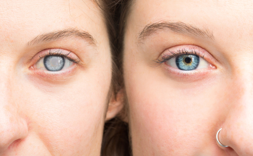 cataract vs normal eye 