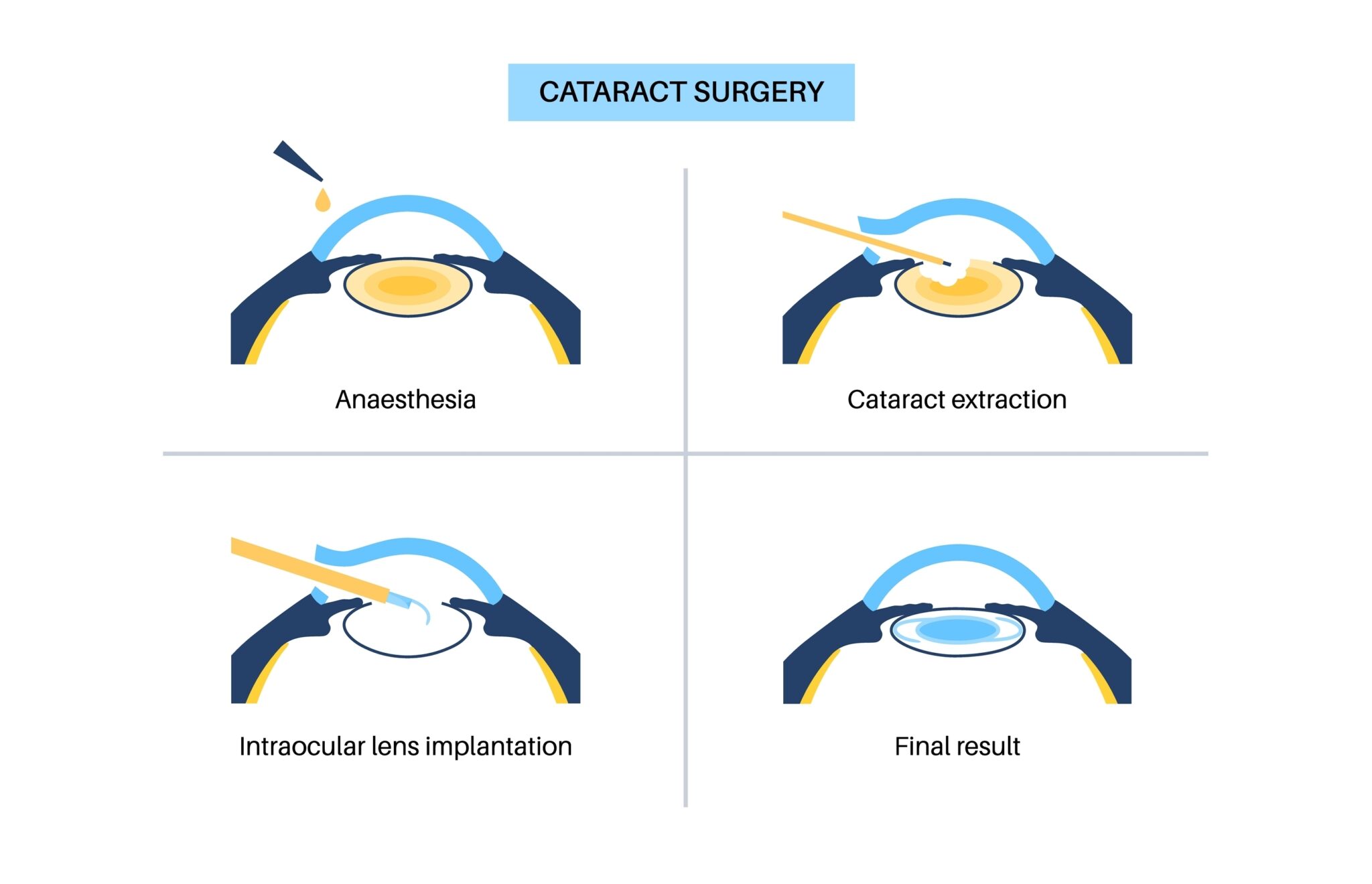 What Is Considered Strenuous Activity After Cataract Surgery Eye What Is Considered Strenuous Activity After Cataract Surgery Eye