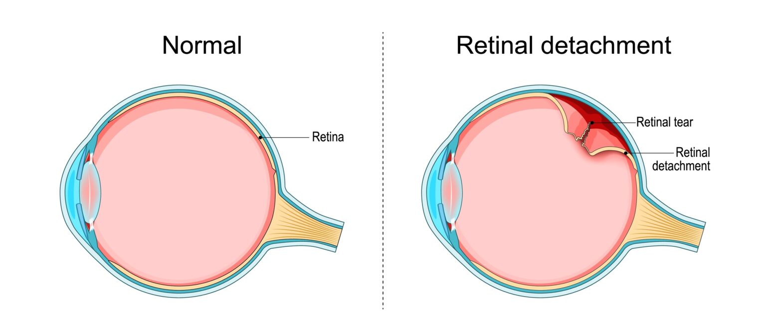 How Can You Recognize The Warning Signs Of Retinal Detachment Eye how-can-you-recognize-the-warning-signs-of-retinal-detachment-eye