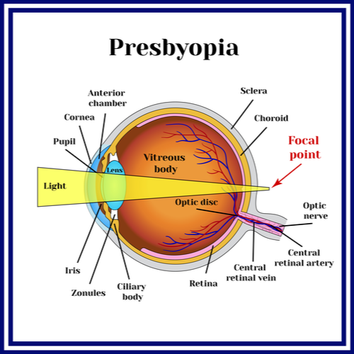 presbyopia