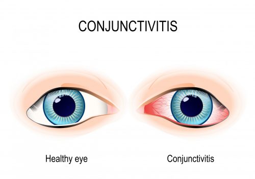 Picture of conjunctivitis 