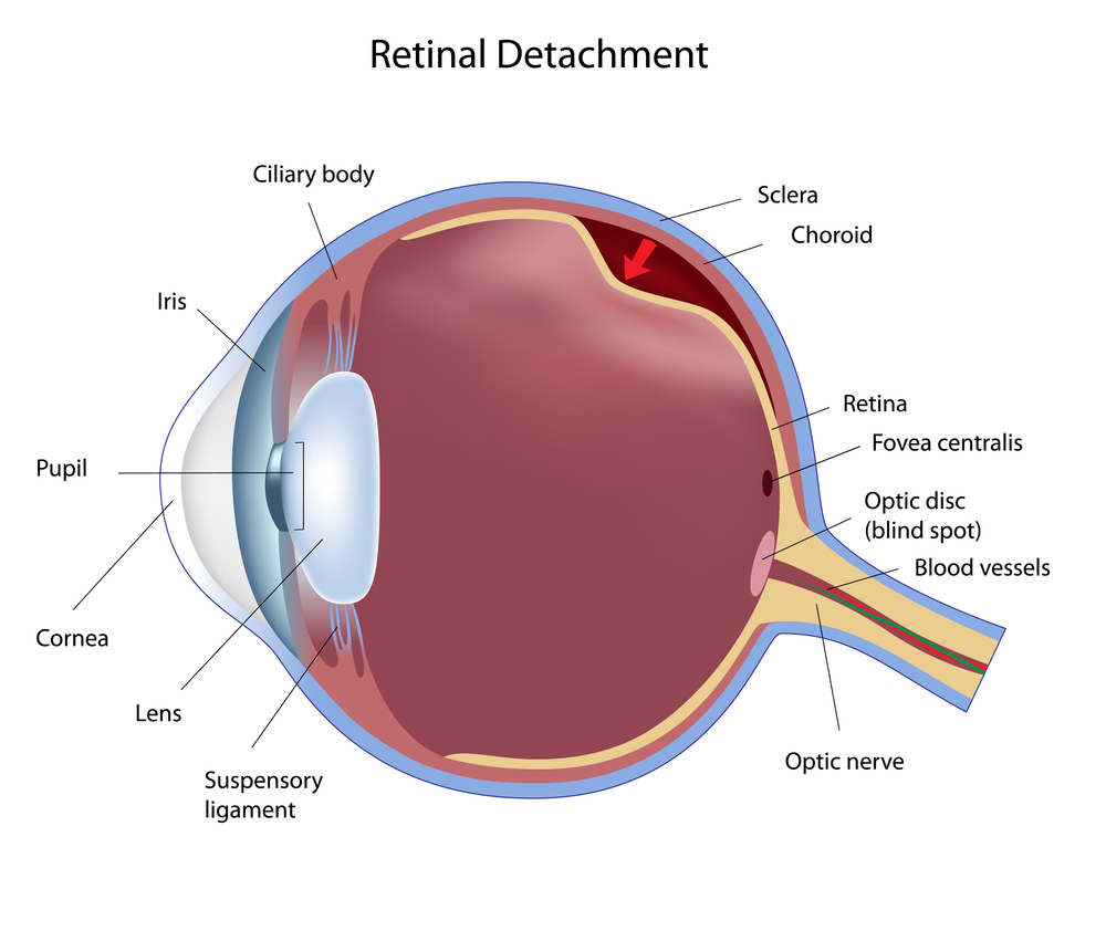 retinal detachment 