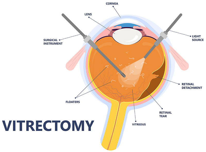 Vitrectomy diagram