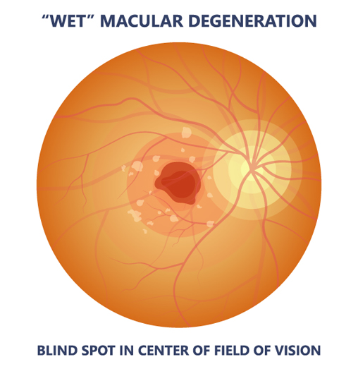 Eye with wet macular degeneration illustration