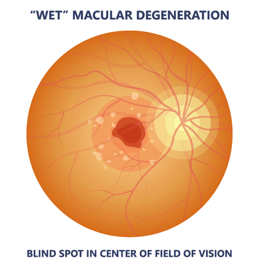 Macular Degeneration Long Beach